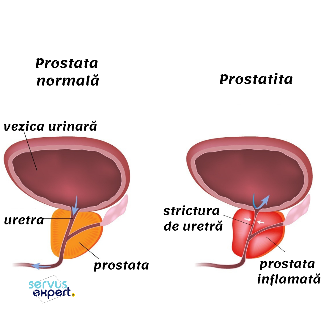 Hiperplasia de próstata benigna