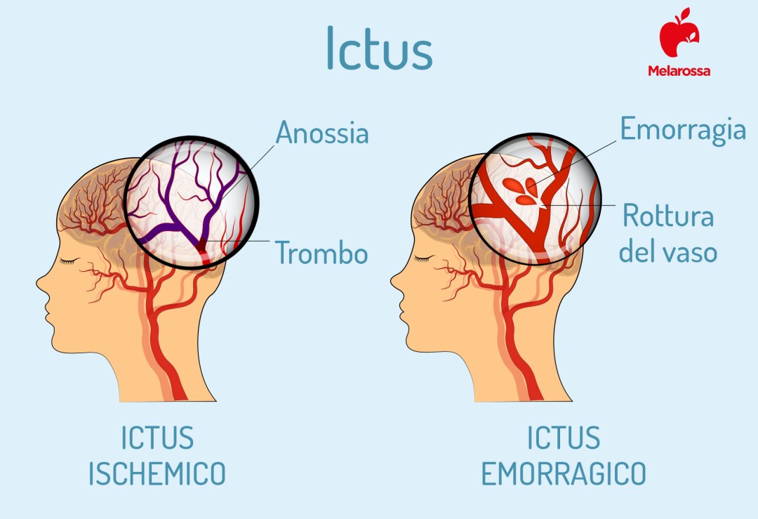 Iktus Neurology