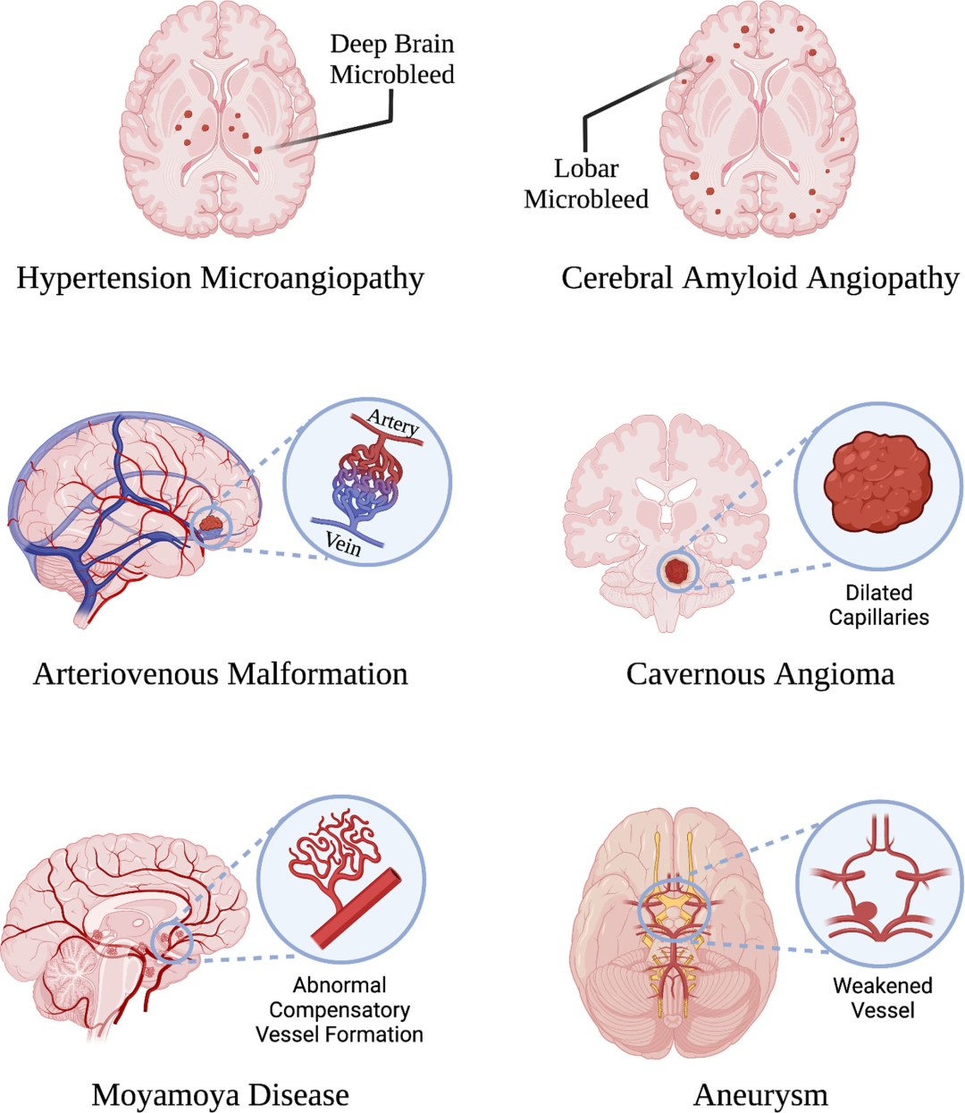 Clasificación Cereberal Hemorage