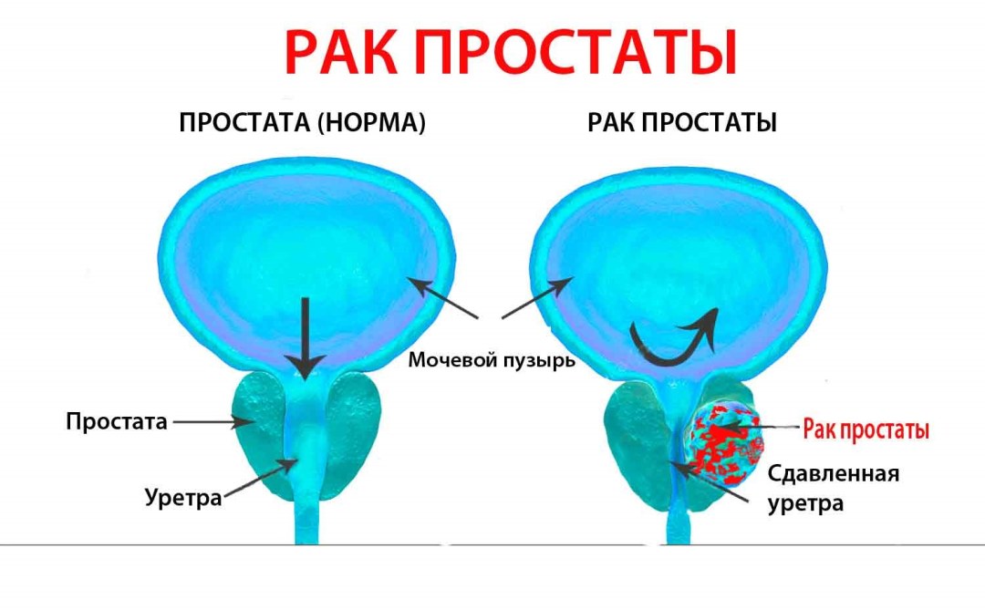 Enfermedades del cáncer de la próstata