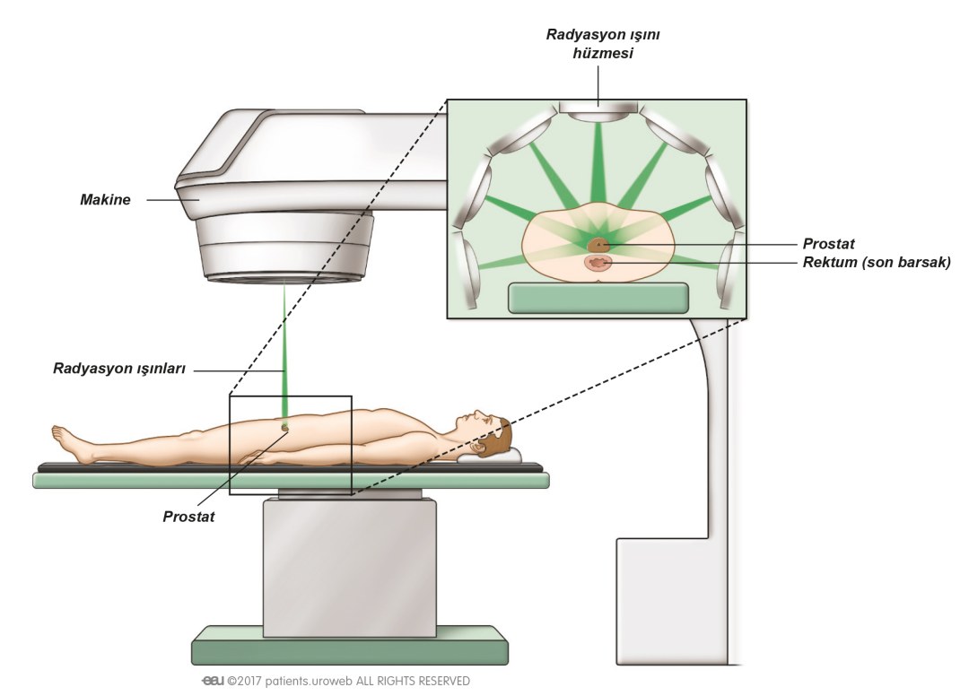 Esquema de radioterapia