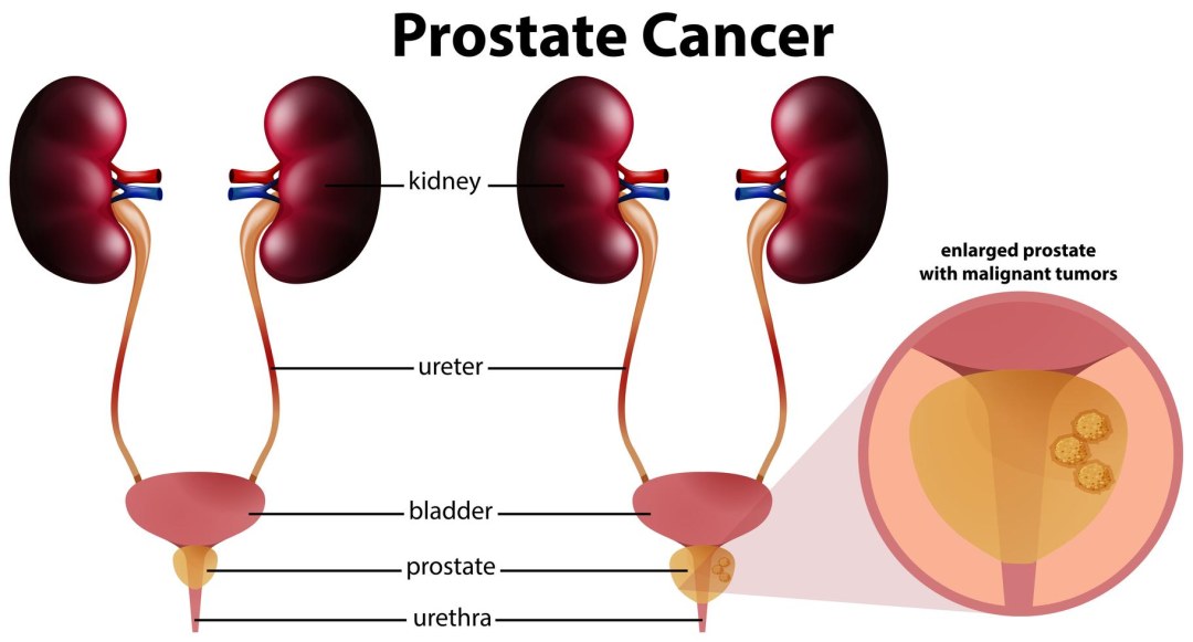 Aplicación de próstata
