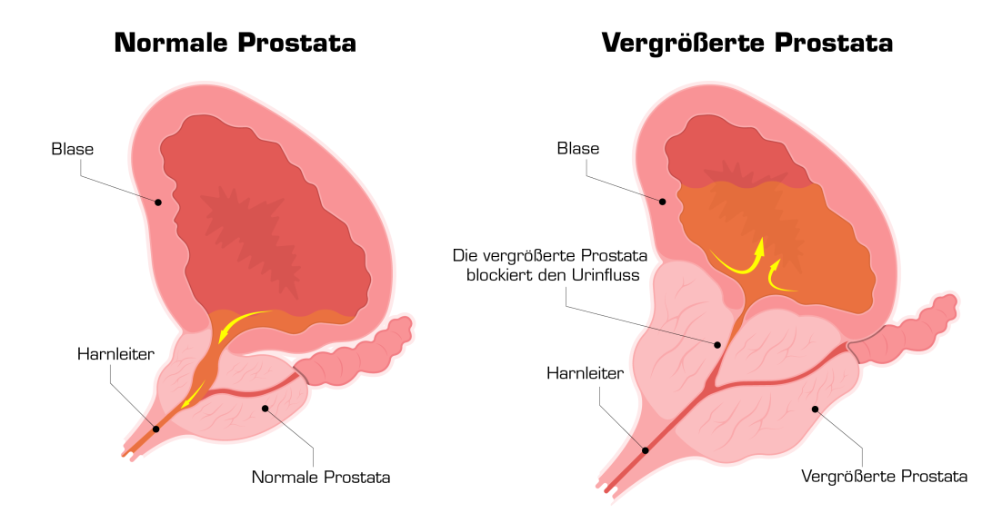 Vector de próstata