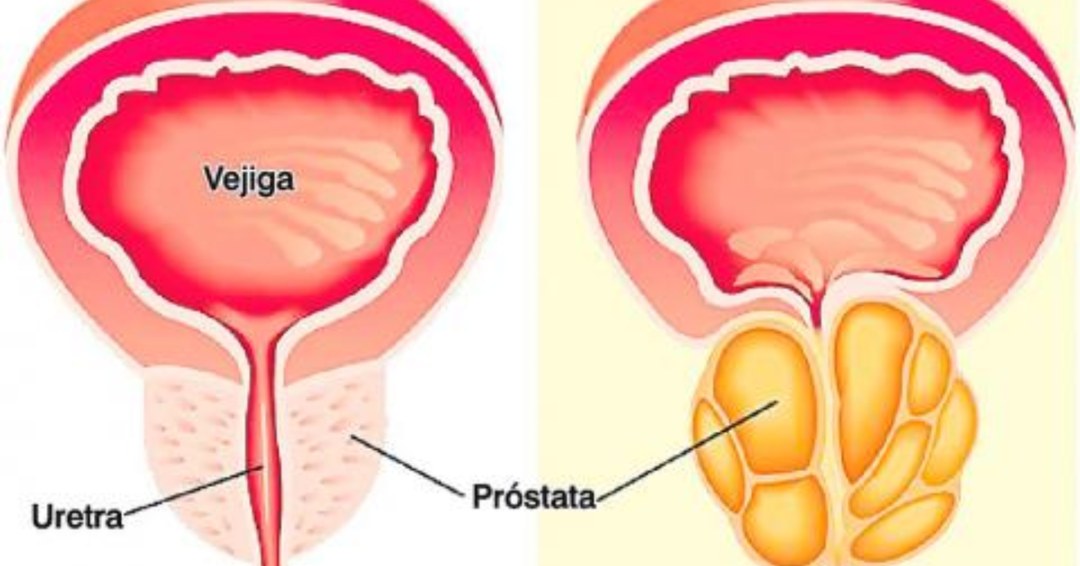 Signos de prostatitis crónica