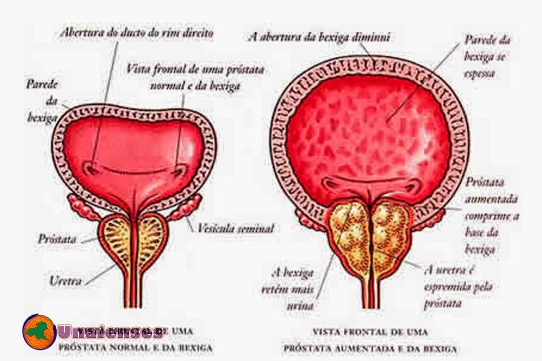 Hipertrofia de próstata benigna