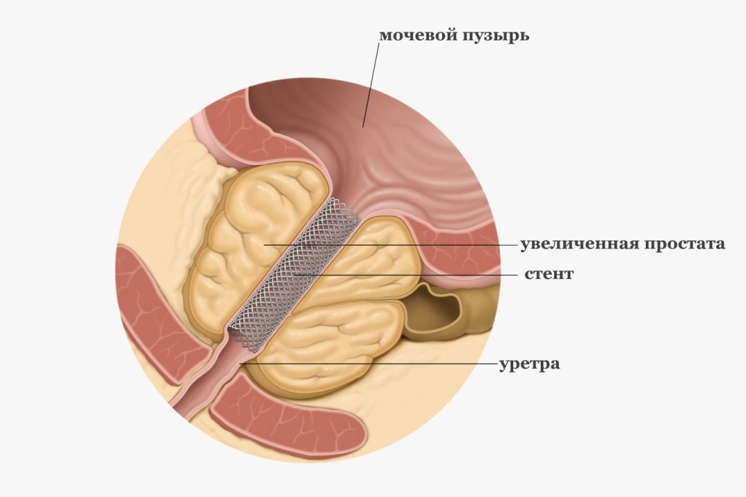 Hipertrofia de próstata