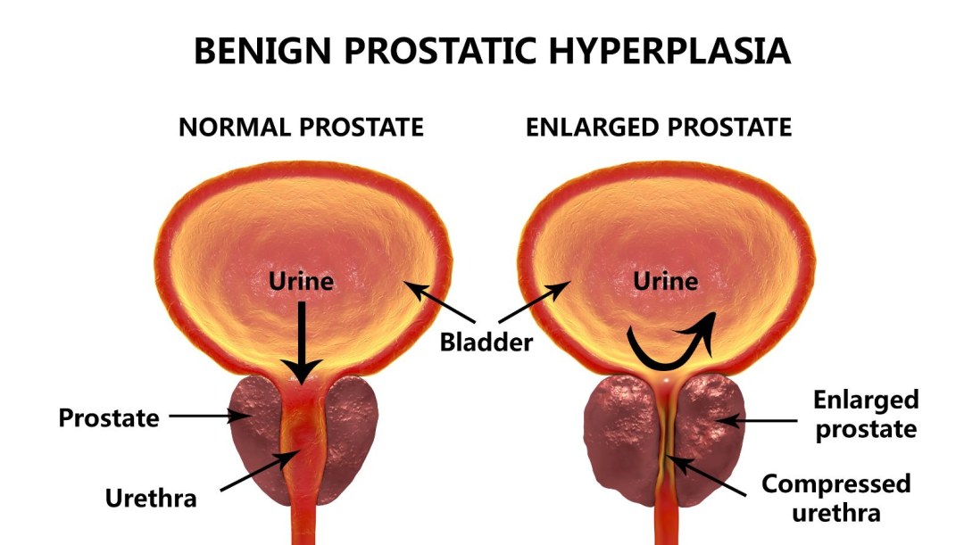 Radioterapia del tumor de próstata