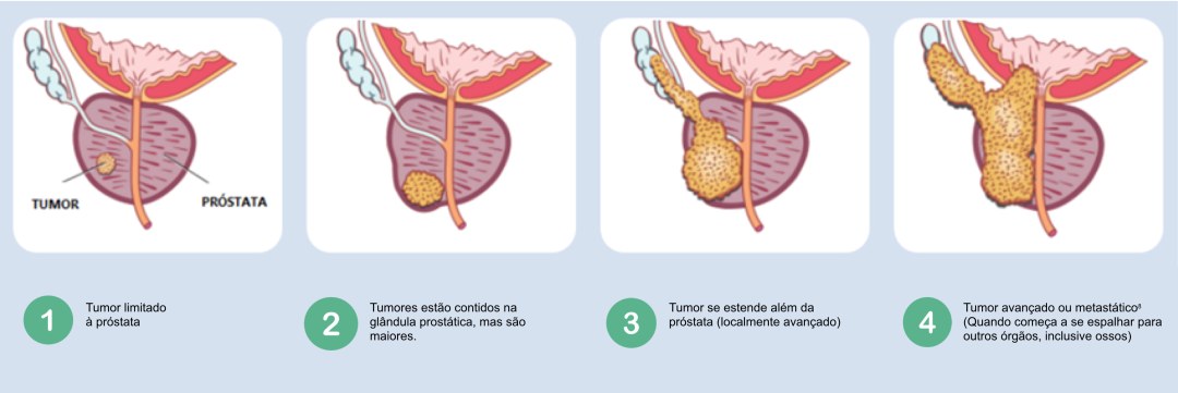 Stent prostático uretral