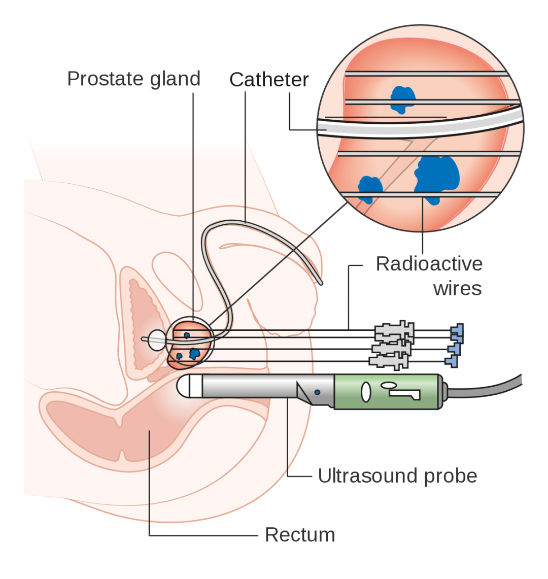 Enucleación láser transuretral del adenoma de próstata