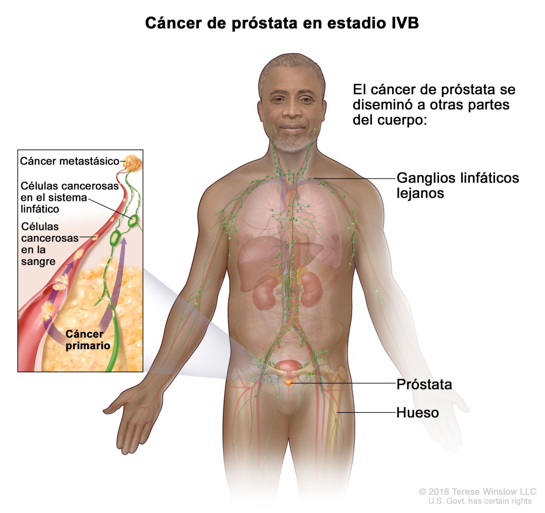 Dibujo de adenoma de próstata