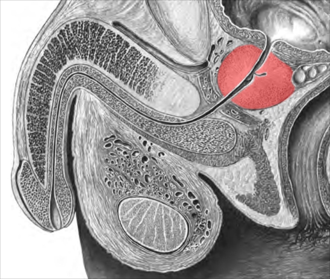 Caricatura de prostatitis