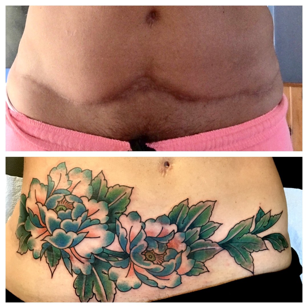 Tatuaje en el estómago después de la cirugía