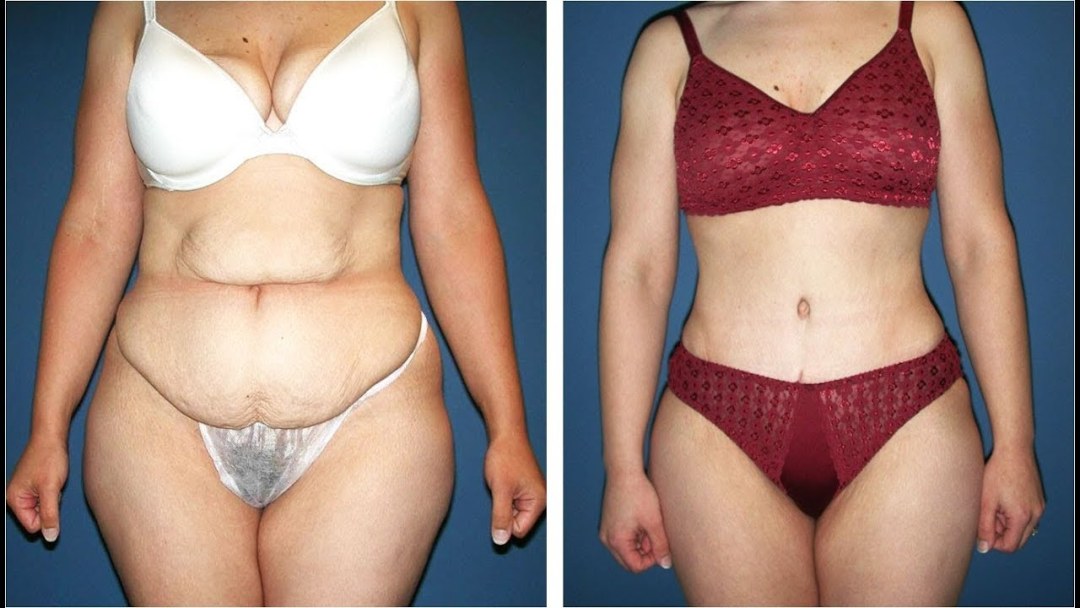 Liposucción del vientre plano