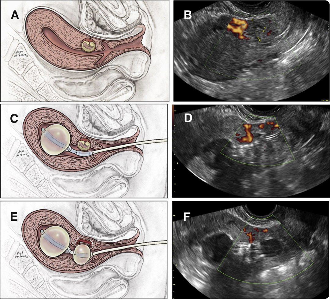 Hentai Fertilización xray