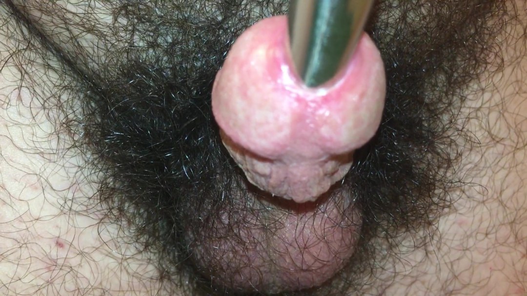 Puño uretral maduro