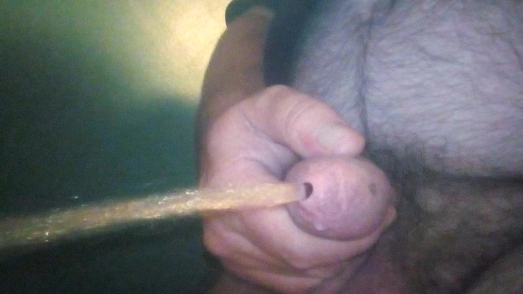 Los chicos terminan sin manos con fimosis