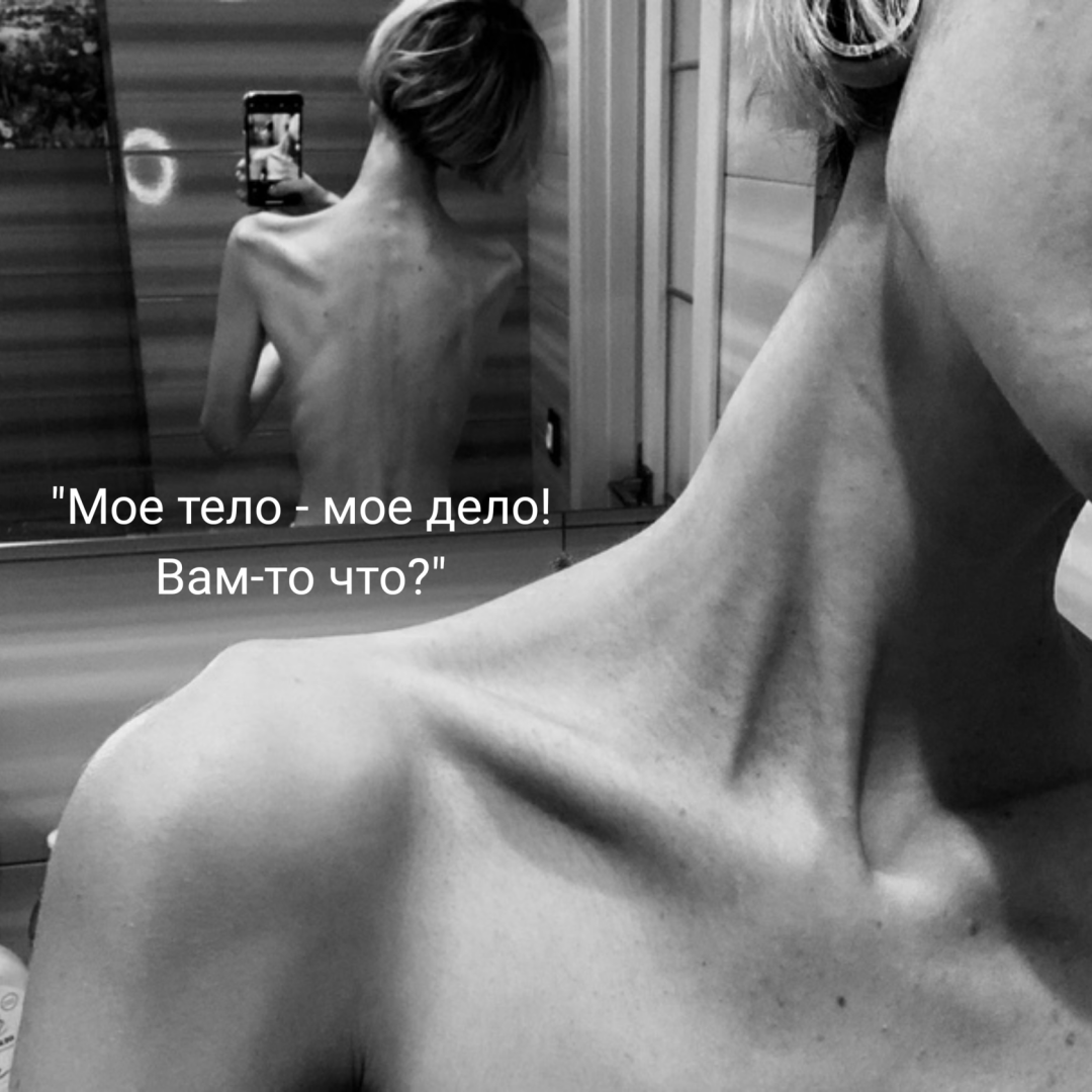 Anorexia dismorfómana