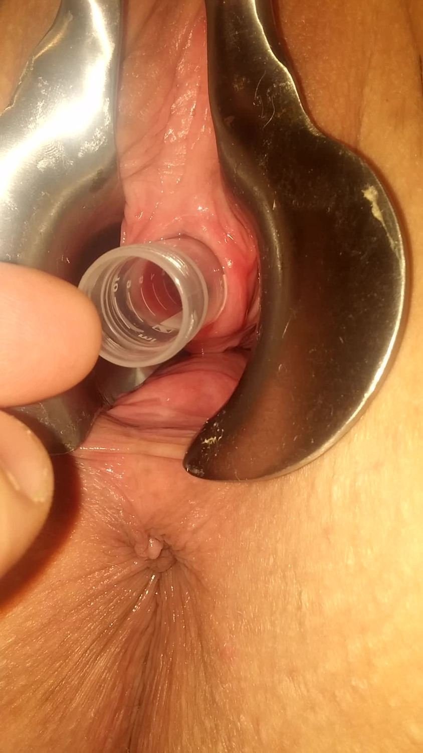 Fisting de una uretra femenina