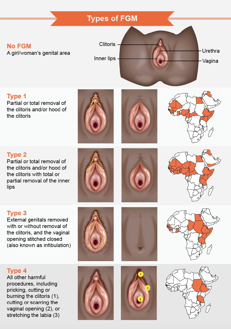Infibulación de circuncisión femenina