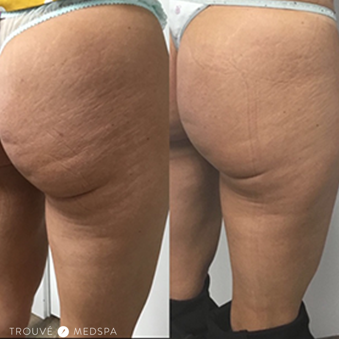 El culo de celulitis es pequeño