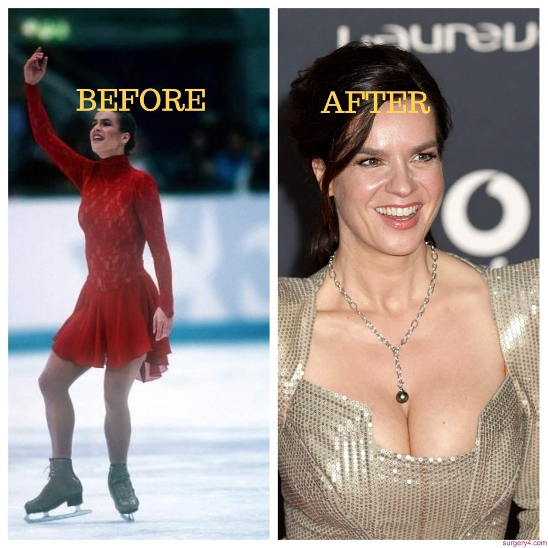 Katarina Witt expuso su pecho