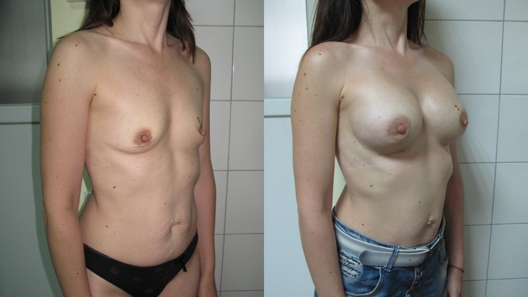 Pequeñas tetas del primer tamaño privado