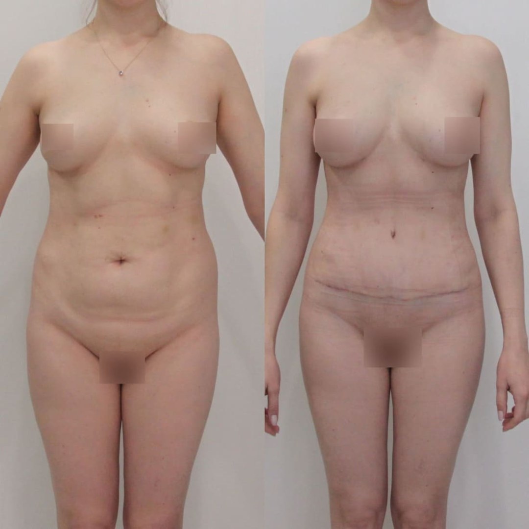 Liposucción del abdomen foto desnuda