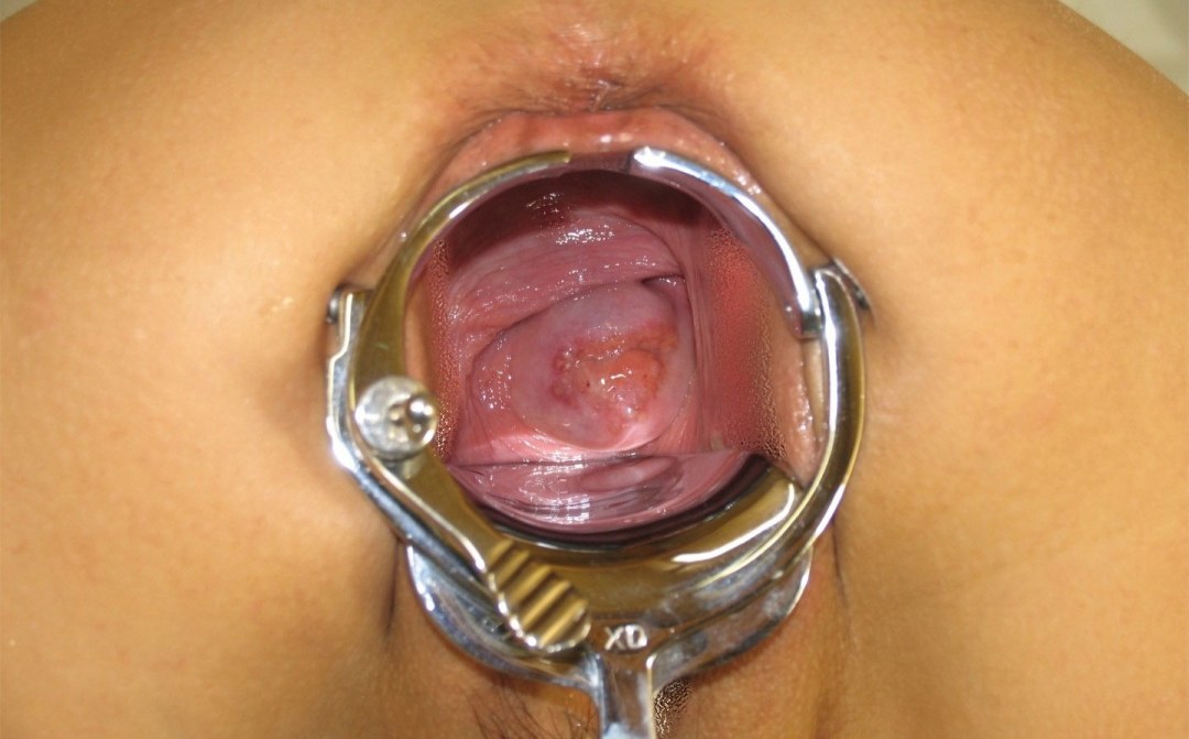 Expansor ginecológico en la vagina