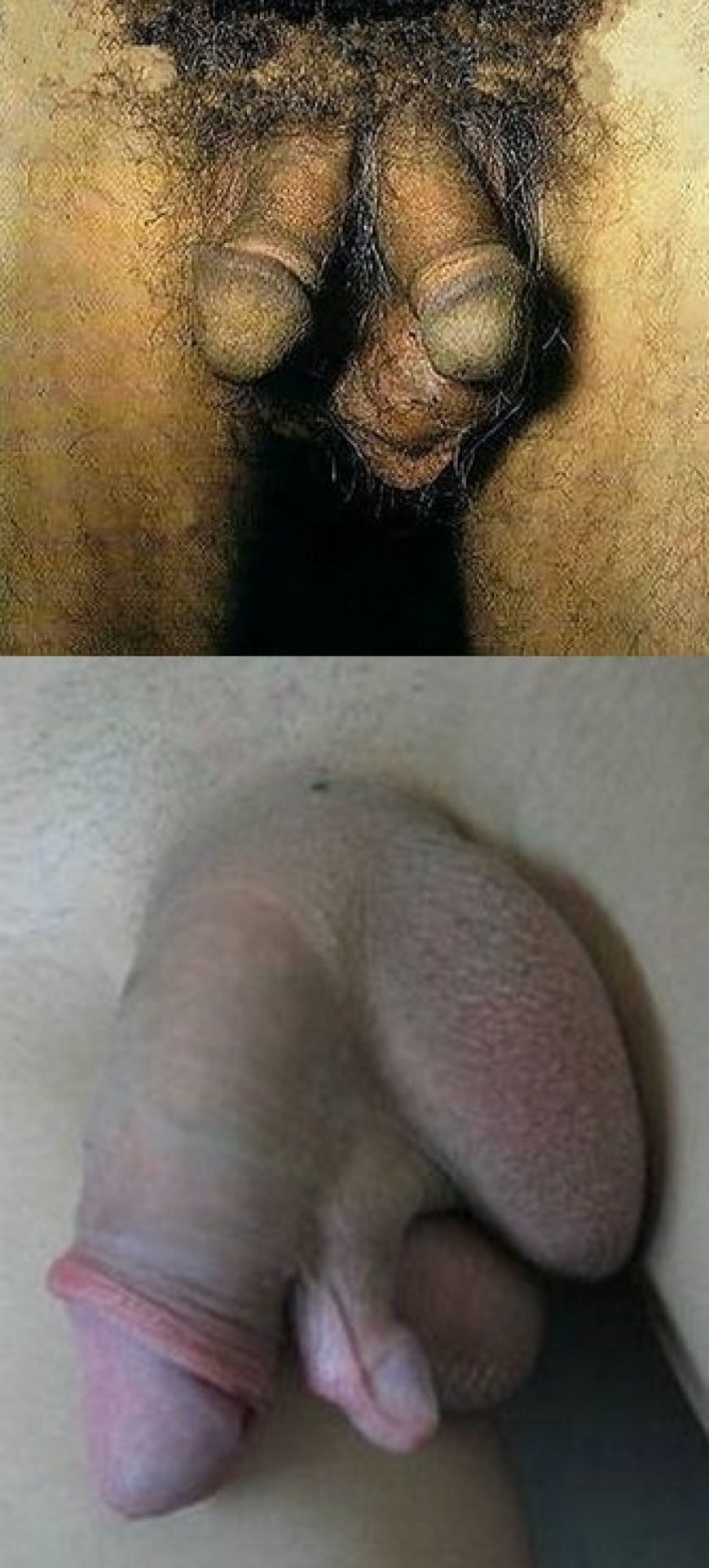 Anomalía dos pene