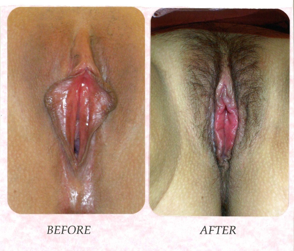 Cirugía plástica de la vagina