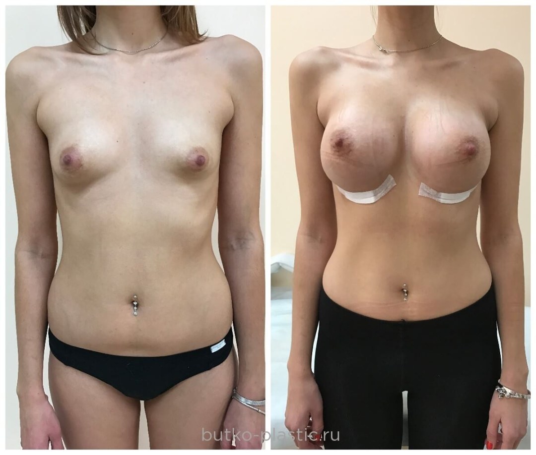 Aumentó las tetas antes y después