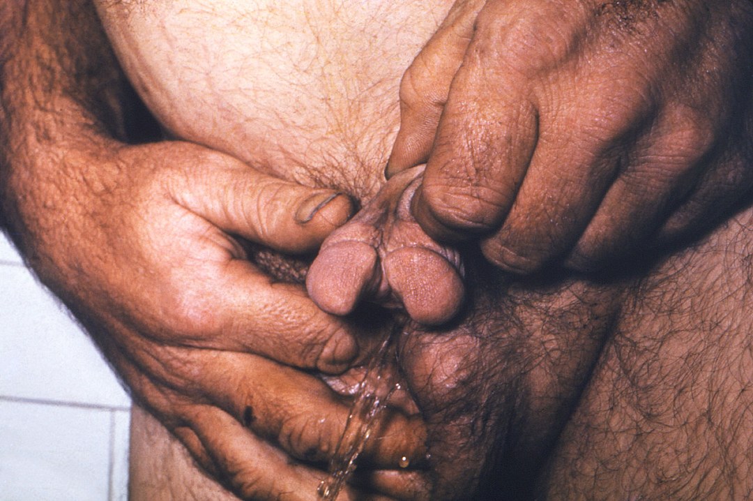 Órganos genitales inusuales en hombres