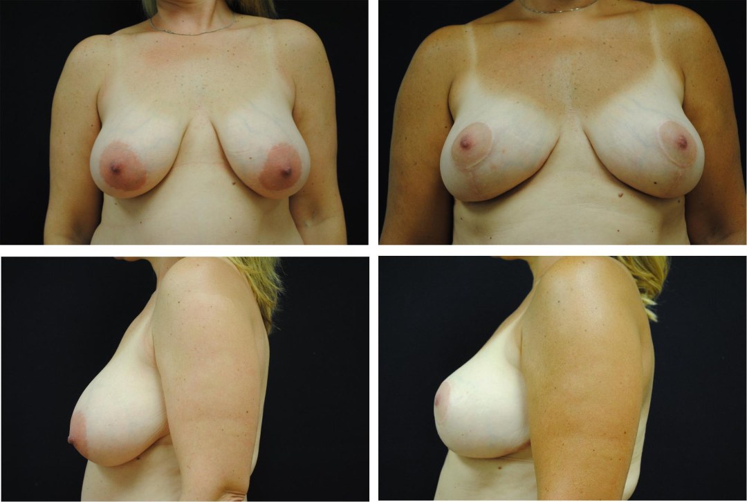 Tetas hundidas 2 tamaños