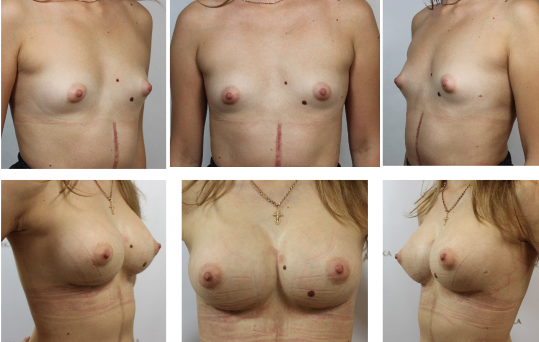 Самый распространенный вид Сисек